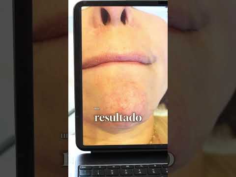 Caso Queixo — Agência Liz
