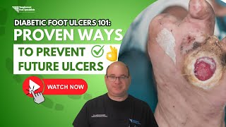 Diabetic Foot Ulcers 101: How to Prevent Ulcers from Coming Back