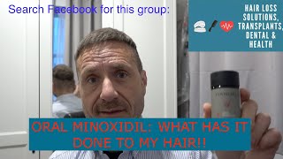 Oral Minoxidil 7 months results - What has it done to my hair? I'm shocked.