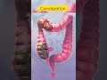 This is how constipation looks inside #viral #shortsvideo Mp3 Song
