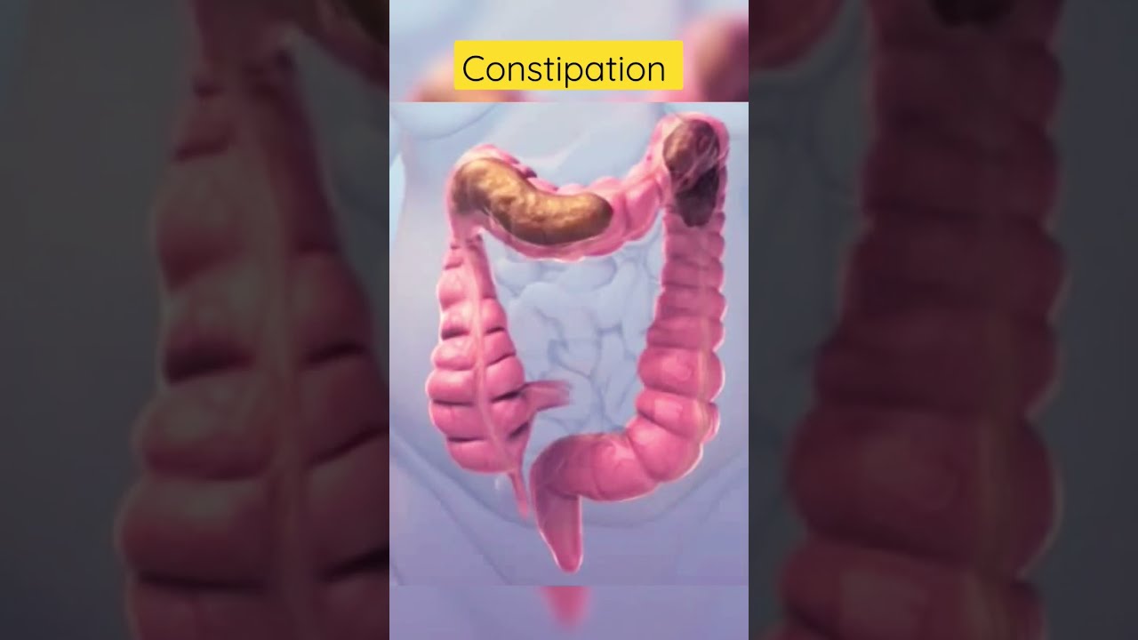 This Is How Constipation Looks Inside Viral Shortsvideo