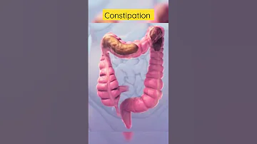 This is how constipation looks inside #viral #shortsvideo