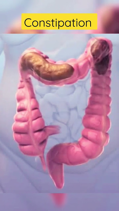 This is how constipation looks inside #viral #shortsvideo