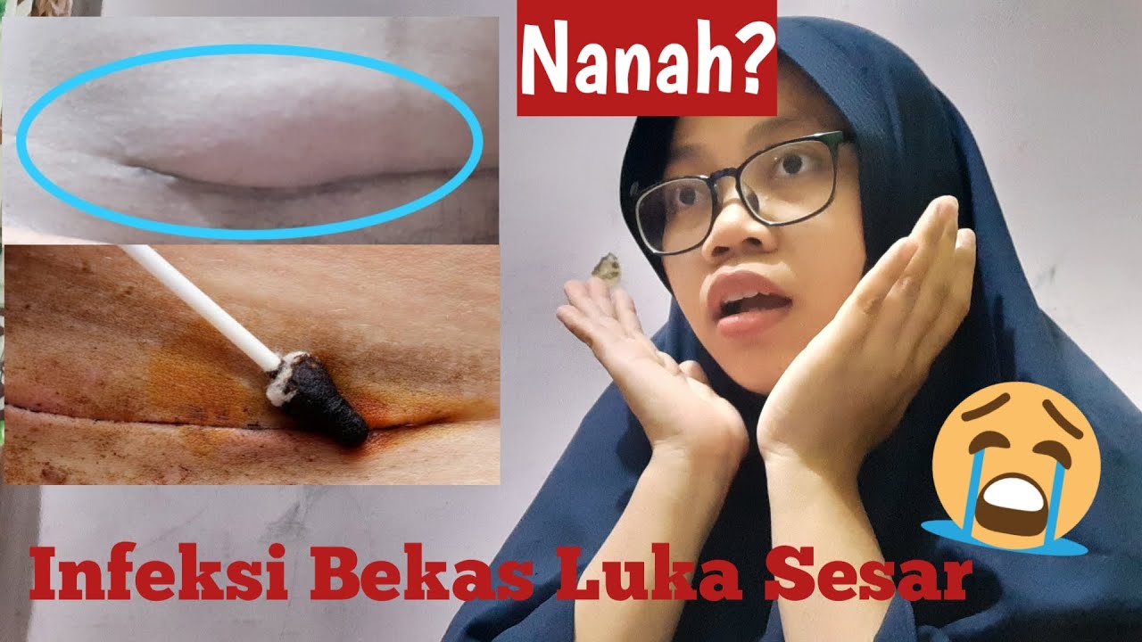 INFEKSI LUKA CAESAR !! Penyebab dan mengatasi, muncul nanah? JANGAN
