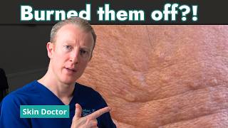Sebaceous Hyperplasia How to Get Rid of Those Little Yellow Bumps on Your Face