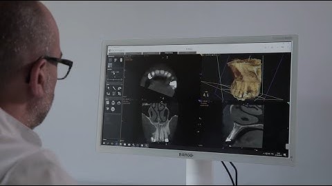 CS 9600 CBCT System – CS MAR with unique live comparison tool