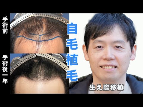 自毛植毛-体験者様のインタビュー - YouTube