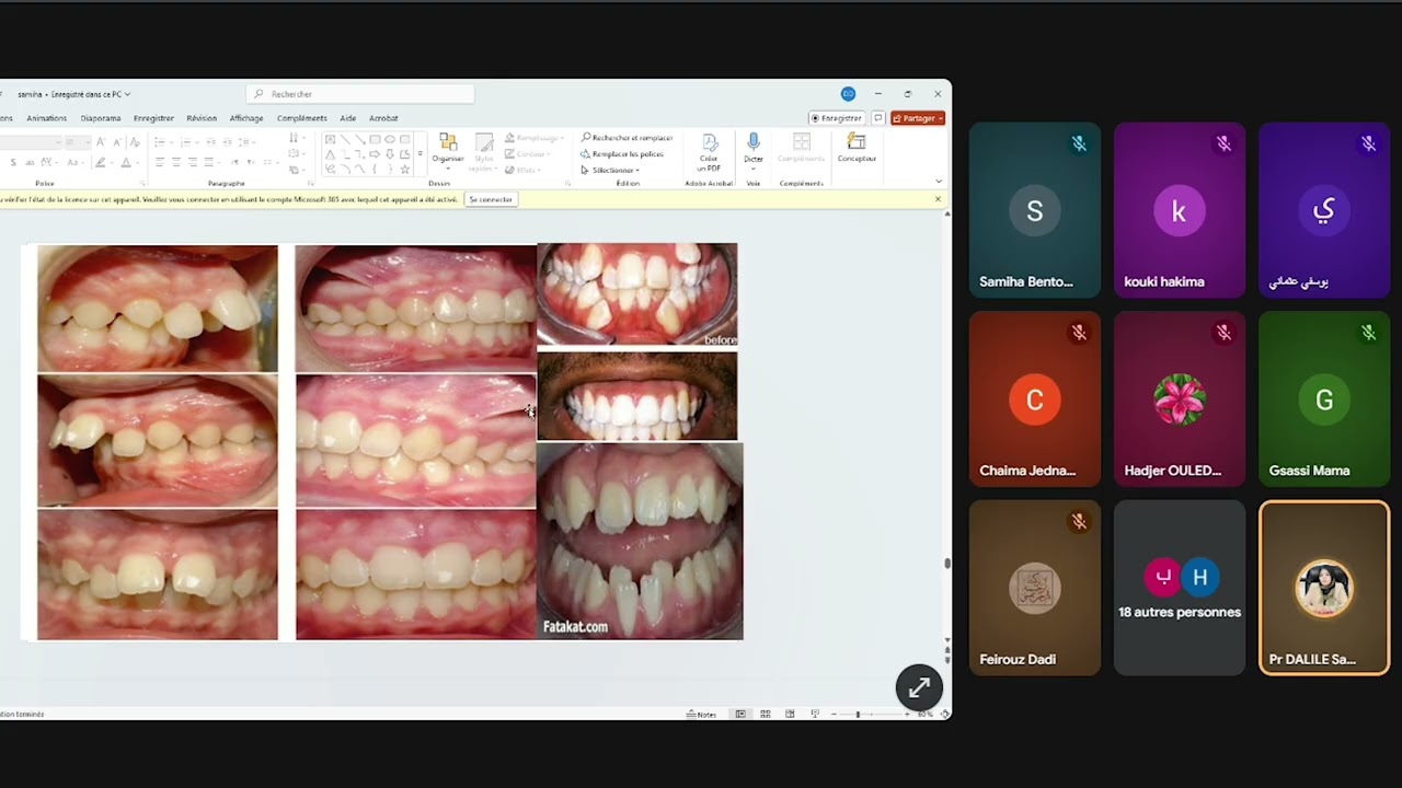 تشوهات الفك والاسنان- اضطرابات النطق العضوية