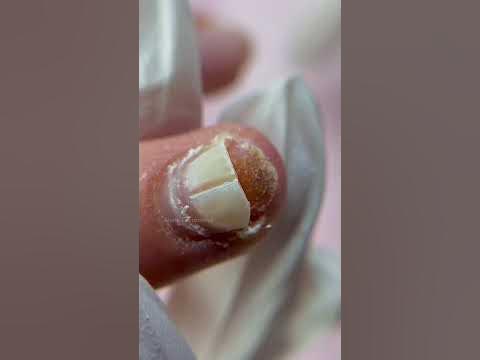 Ноготь отошел от пальца! Травма ногтя Что делать? Зачистка онихолизиса ...