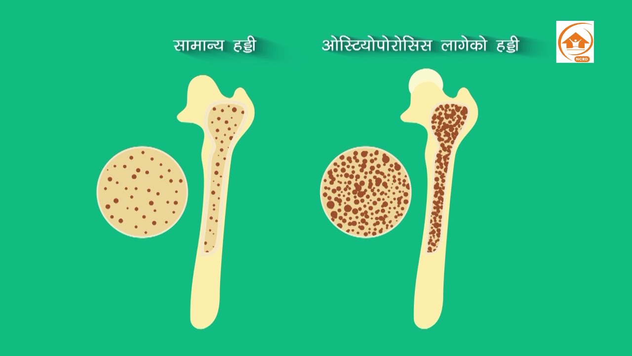 हड्डी मक्किने समस्या बारे जान्नै पर्ने कुराहरु