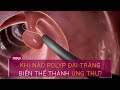 Khi nào polyp đại tràng biến thể thành ung thư? | VTC Now