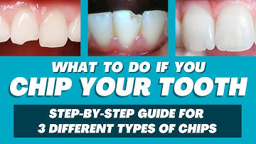 What to Do If You Chip Your Tooth | Step-by-Step Guide for 3 Different Types of Chips
