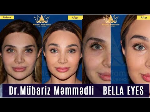 Ülviyyə Xəlilbəkovanın möhtəşəm dəyişim əməliyyatı. Bella Eyes Dr. Mübariz Məmmədli / Plastik cərrah