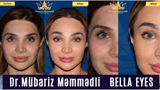 Ülviyyə Xəlilbəkovanın Möhtəşəm Dəyişim Əməliyyatı Bella Eyes Dr Mübariz Məmmədli Plastik Cərrah