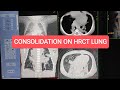 Consolidation on HRCT of Lungs | 1.5 month 👶Baby.