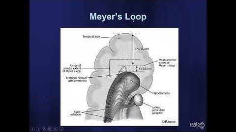ESTM Webinar Series: Global Epilepsy Surgery Technique Rounds 2nd Session