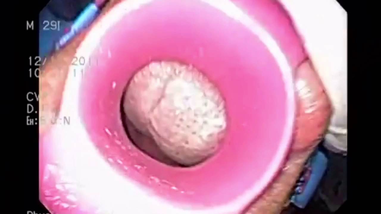 Gastroscopy. YouTube