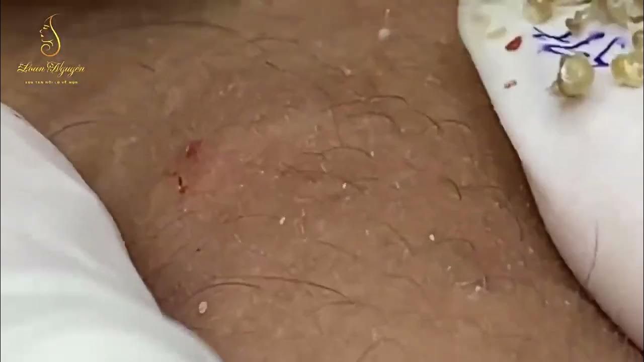 massive blackheads on nose and lips Clean Giant Blackheads on Nose