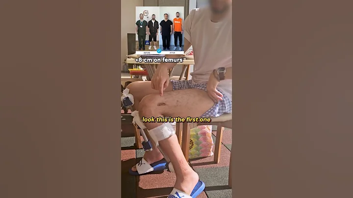 Would You Do Limb Lengthening Again? Here’s His Answer