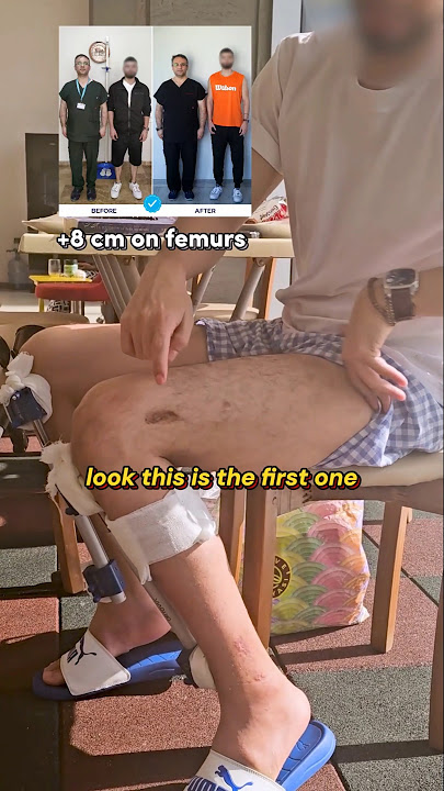 Would You Do Limb Lengthening Again? Here’s His Answer