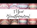 My 1 Year Braces Journey