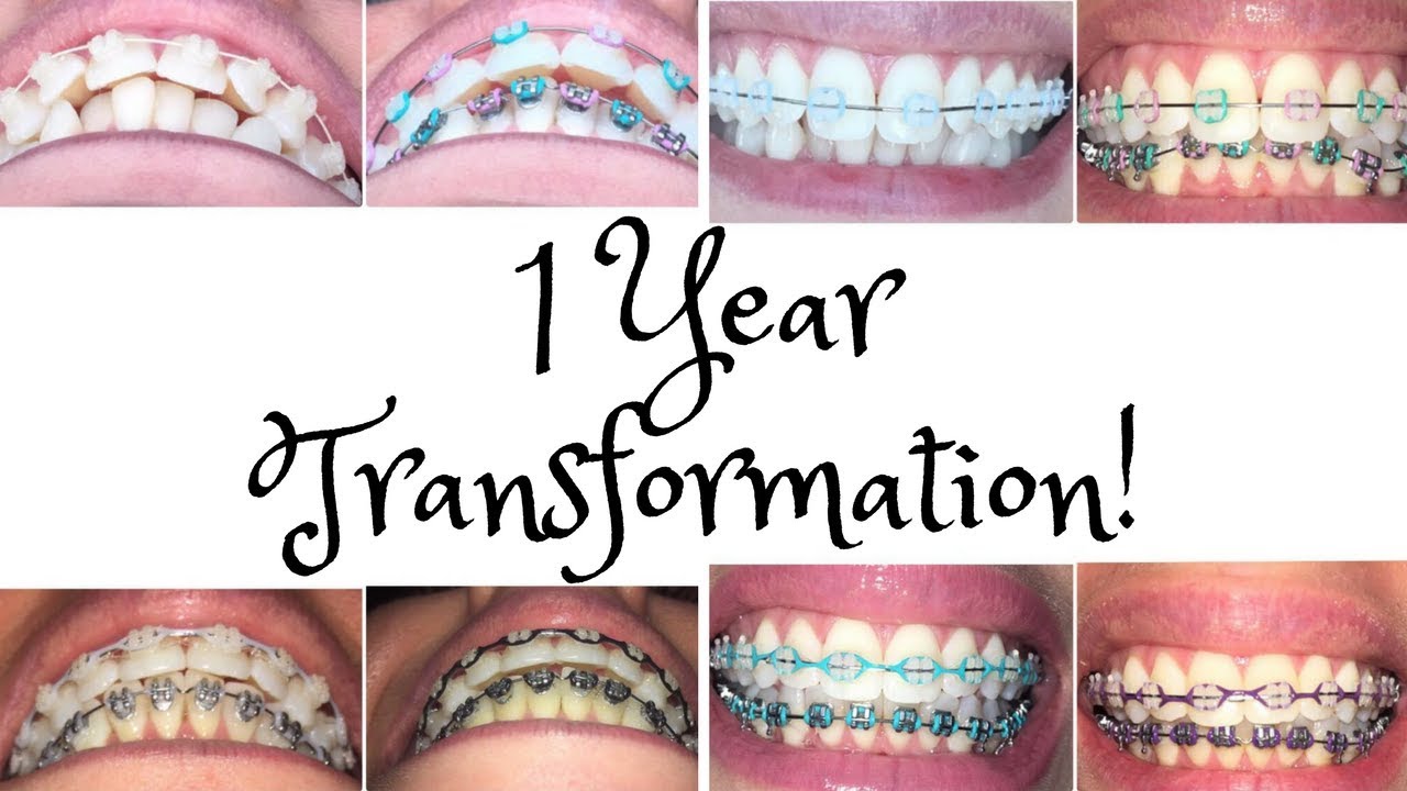 fast braces journey