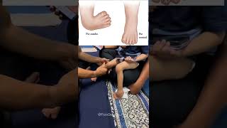PIE EQUINOVARO.#pieequinovaro #fisioterapia #Kinesiología #rehabilitacion #FisioPeruana