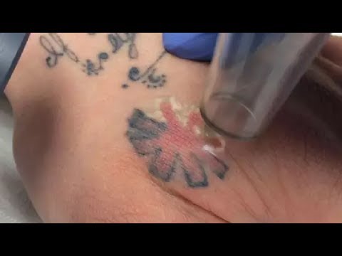 best tattoo removal you do it yourself at home youtube best tattoo removal you do it yourself at home youtube