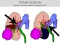 Virtual partial nephrectomy analysis; 解剖学的腎部分切除の手術計画とその有効性