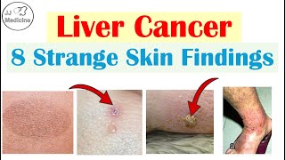 Before the Diagnosis: 8 Skin Findings Linked to Liver Cancer