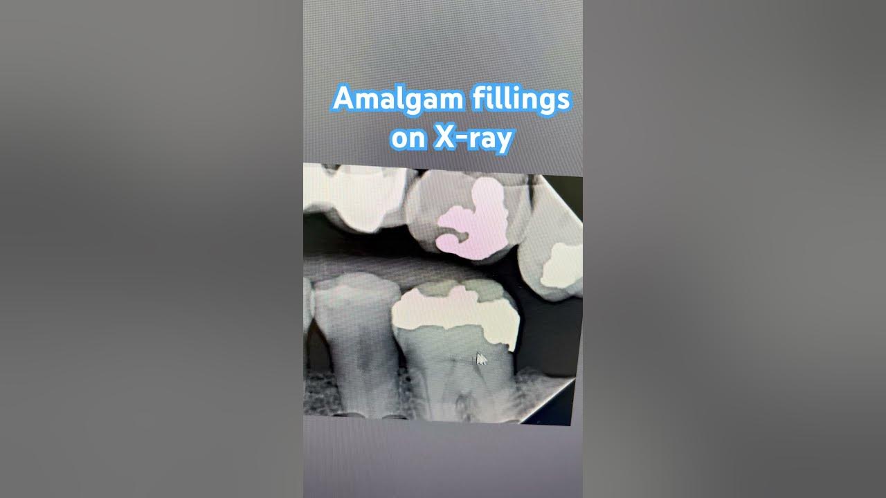 Amalgam fillings on xray filling toothcare dentist xray tooth