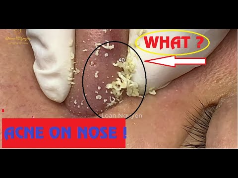 ACNE REMOVAL on NOSE_too much_LẤY MỤN TRÊN MŨI | Loan Nguyen