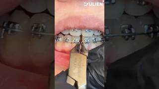 Watch Orthodontist Tighten Closing Loop #braces #asmr
