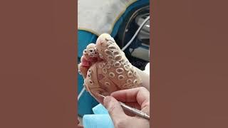 Pedicure#136/Peeling skin/foot wart/hardskin/FOOT CALLUS/FUNGAL NAIL/CORN TREATMENT/足底疣