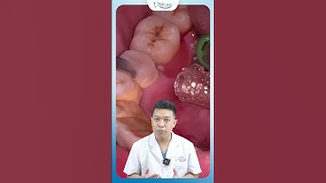 Đừng Đi Lấy Cao Răng Nếu Bạn Không Muốn Răng Bị Như Thế Này | Nha Khoa Minh Châu