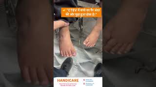 CTEV AFO #artificiallimb #foot #ctev
