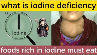 what is iodine deficiency | iodine deficiency signs and symptoms | How to prevent iodine deficiency