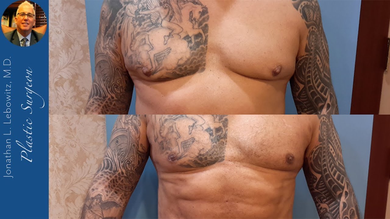 1 Month Before & After HiDef VaserLipo Surgery By Dr