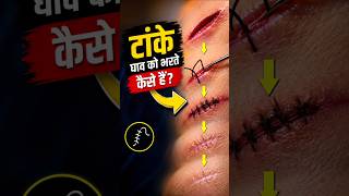 The Science Behind Stitches 🩹💥Hindi Storytelling Video | Suspense Story | Viral Shorts #shorts