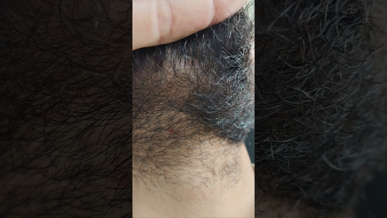 ingrown hair satisfying videos