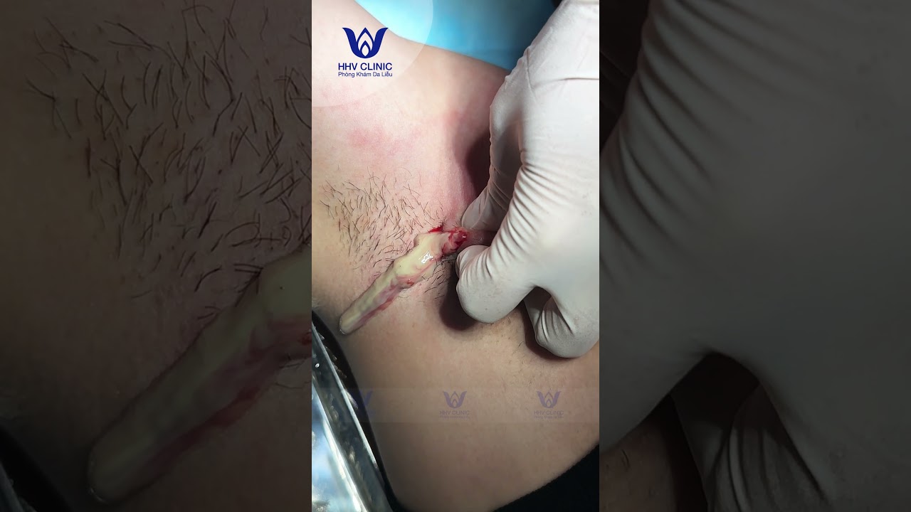 NÁCH SƯNG TO NHƯ QUẢ TRỨNG – KẾT QUẢ BẤT NGỜ.