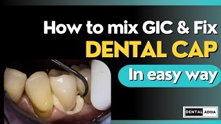 How To Mix Gic For Luting Consistency Dental Crown Fixing Procedure