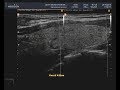 Видеозапись УЗИ - Измерение длины доли щитовидной железы на двойном экране