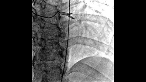 Coronary heart disease video
