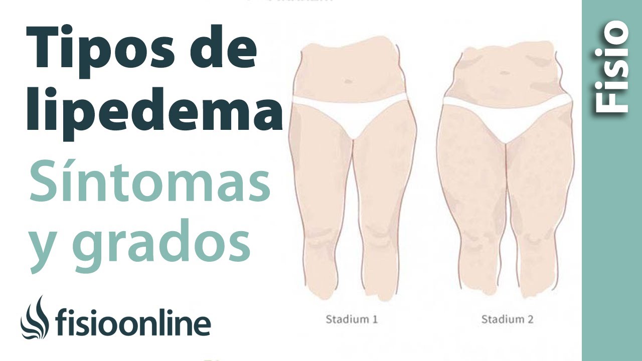 Caso clínico: Lipedema grado I-II en miembros inferiores