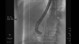 Management of pancreatic duct disruption using the Exalt single-use duodenoscope