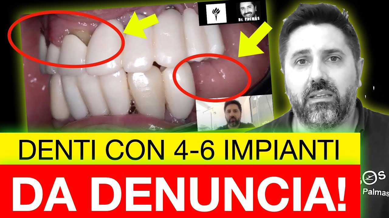 Denti con 4 o 6 Impianti: Denunciare il Dentista che ti ha truffato?