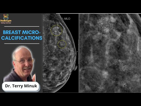 Mikrozwapnienia w piersiach: wszystko, co musisz wiedzieć | Mammografia | dr Terry Minuk