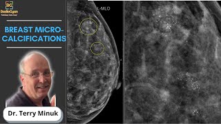 Mastering Mammography: Understanding Breast Microcalcifications | Dr. Terry Minuk