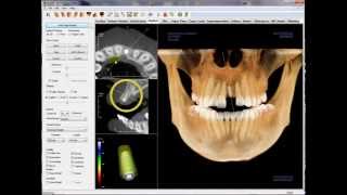 3D Implant Planning with the Invivo5 Software